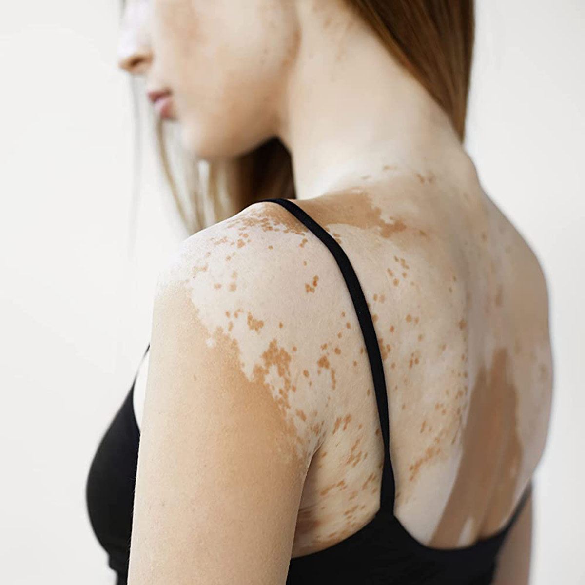 Tratamiento Cosmético para manchas Blancas o Vitíligo Repigment12 image number null