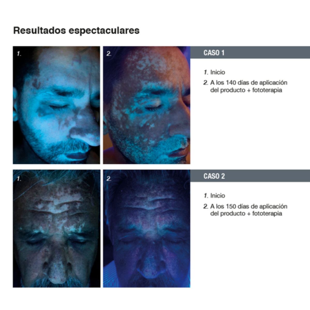 Tratamiento Cosmético para manchas Blancas o Vitíligo Repigment12 image number null